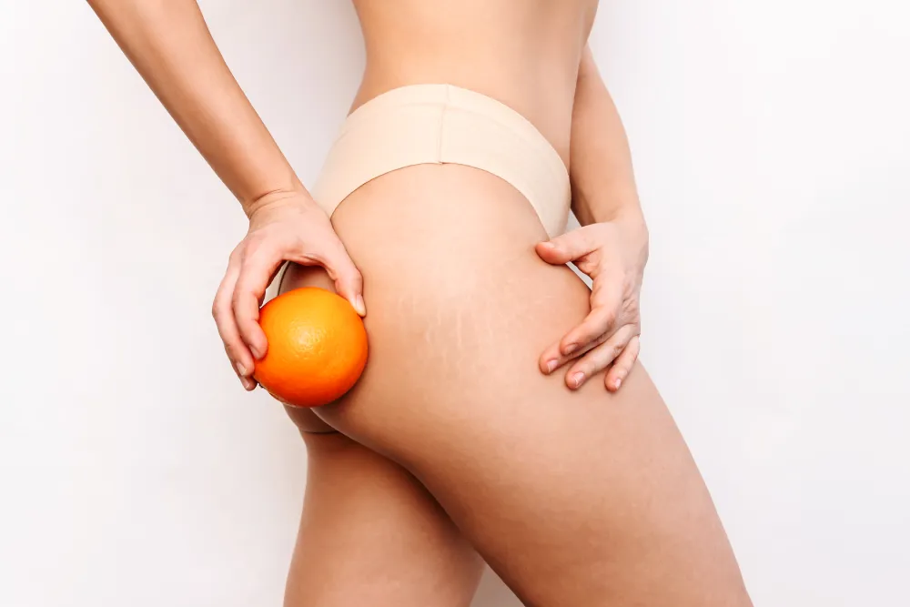 Selülit Mezoterapisi