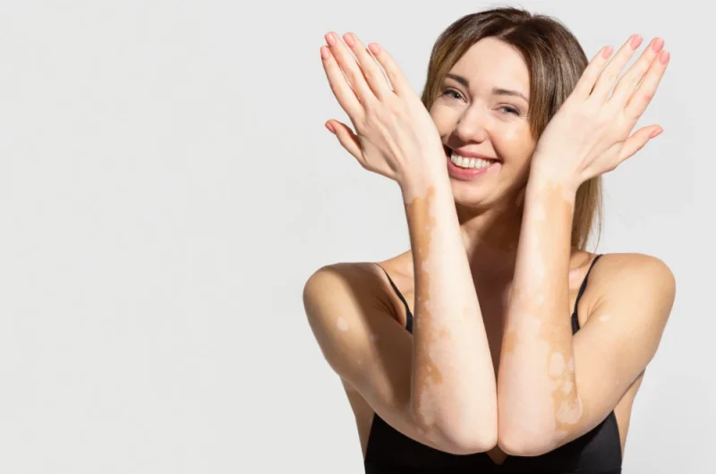 Vitiligo